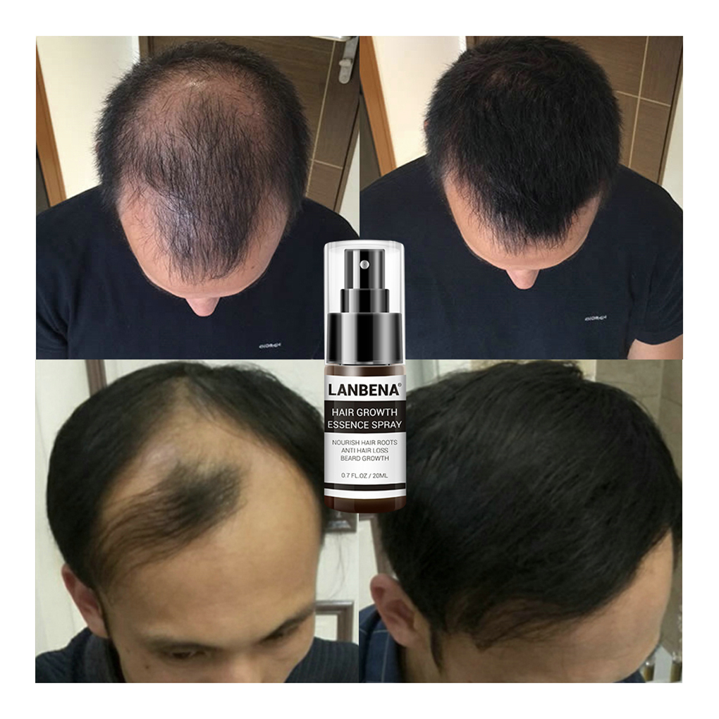 LANBENA 20ml Hair Growth Essen - Hair Care Essence Oil Spray reseña y precio